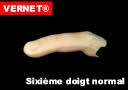 Sexto dedo Normal (Vernet)