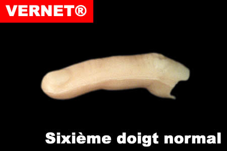 Sexto dedo Normal (Vernet)